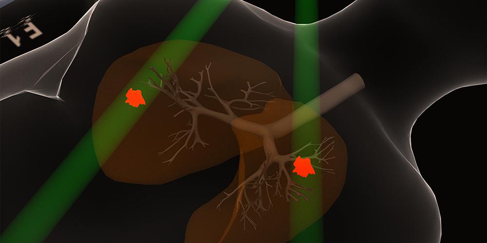 A scan of small-cell lung cancer